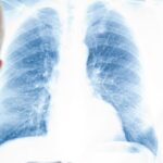 Лікування раку в Україні під час війни: блекаути, обстріли та боротьба за кожен день терапії 41 Screenshot 66 8