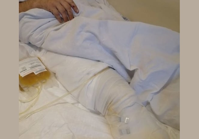 У Біленькому FPV-дрон атакував автомобіль — 33-річному водієві ампутували ногу 1 amputant2